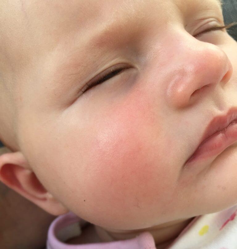 Allergies: Tips On How To Cope & Lead A Normal Life